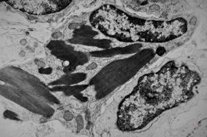 jejunum … celiakia … Charcot-Leyden crystals v.s. jejunum … celiakia … Charcot-Leyden crystals v.s.